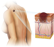 Squamous-cell-carcinoma-or-squamous-Tunisia